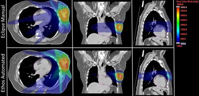 Leveraging intelligent optimization for automated, cardiac-sparing accelerated partial breast treatment planning